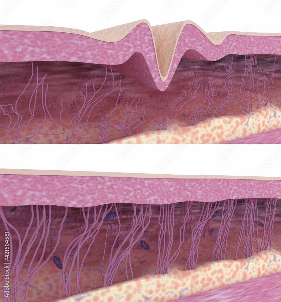 Hyaluronicacidskinplumping