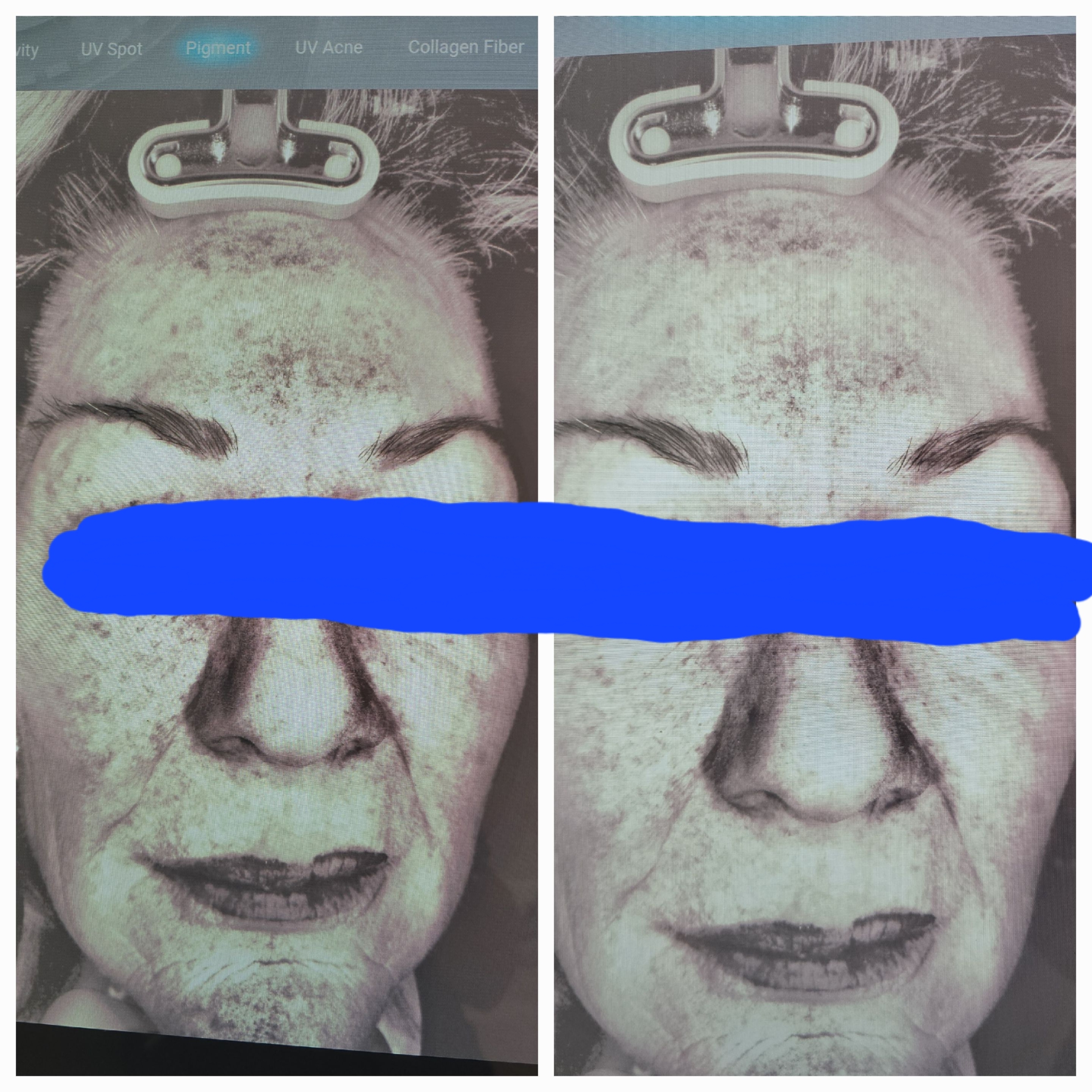 Skin aging reversal