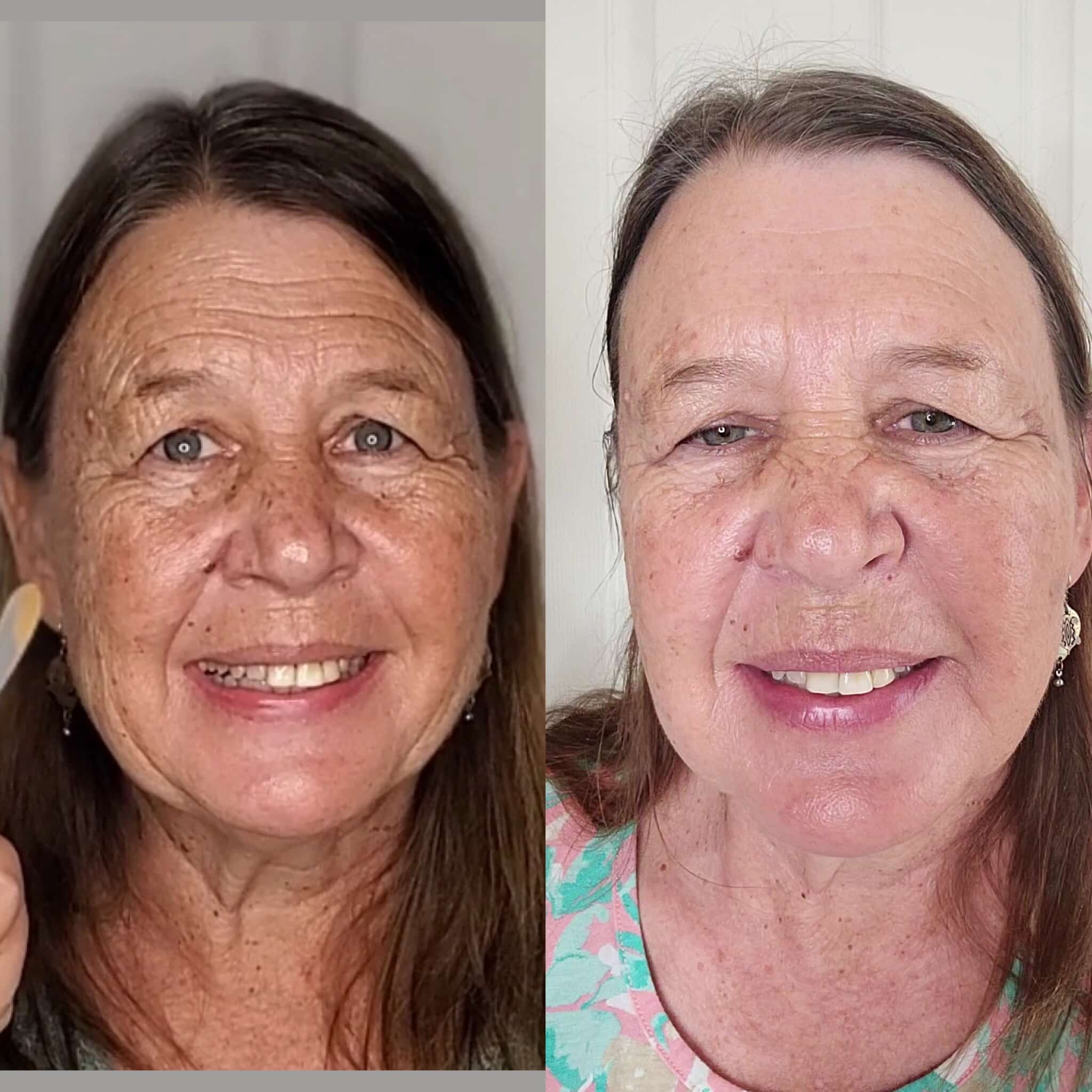 Before and after Wrinkles