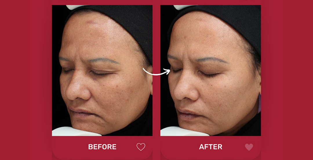 Illuminate Pea Peptides Melasma Serum
Shop Illuminate